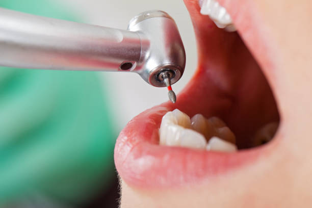 Best Knocked-Out Tooth (Avulsed Tooth) Treatment in Iroquois Point, HI